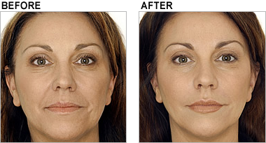 Before and After Juvederm