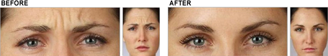 Before and After Botox