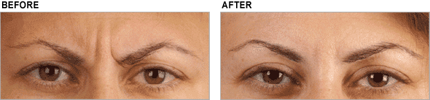 Before and After Botox