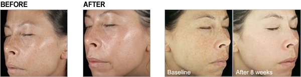 Before and After Vivite